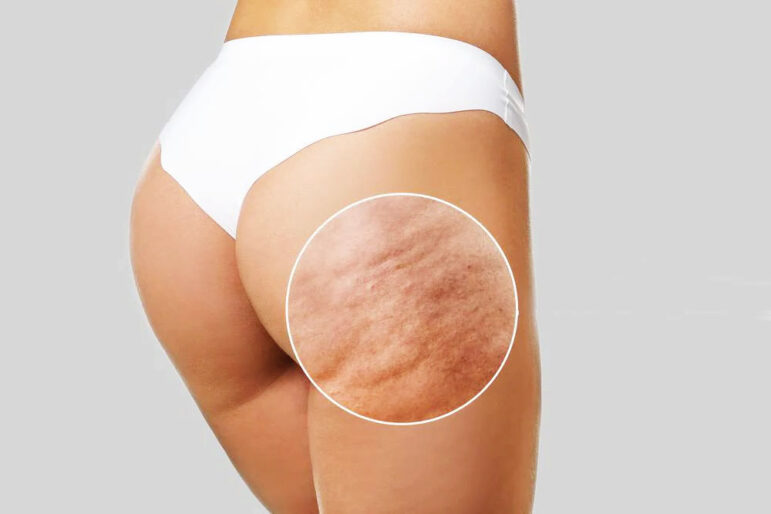 Can you treat cellulite with red light therapy